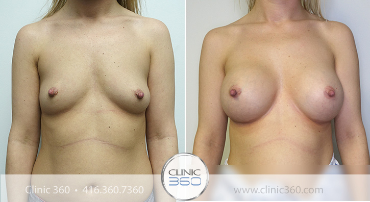 Breast Augmentation Before & After Photos - Clinic 360