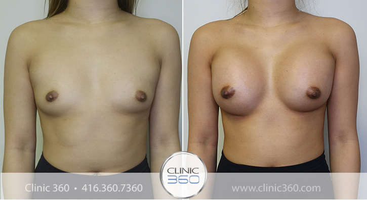 Breast Augmentation Before & After Photos - Clinic 360