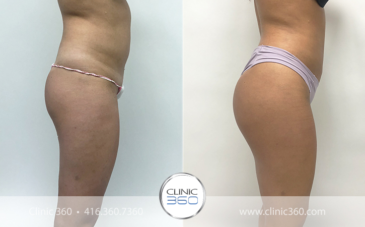 Brazilian Butt Lift Before & After Photos - Clinic 360