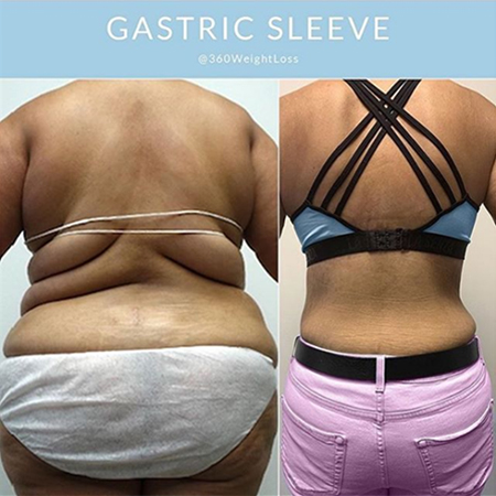Gastric Sleeve Surgery Before & After Photos - Clinic 360