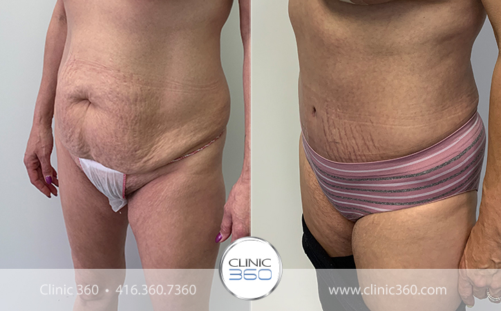 Tummy Tuck Before & After Photos - Clinic 360
