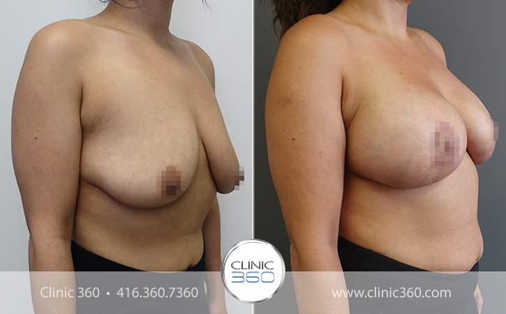Breast Lift Before & After Photos - Clinic 360
