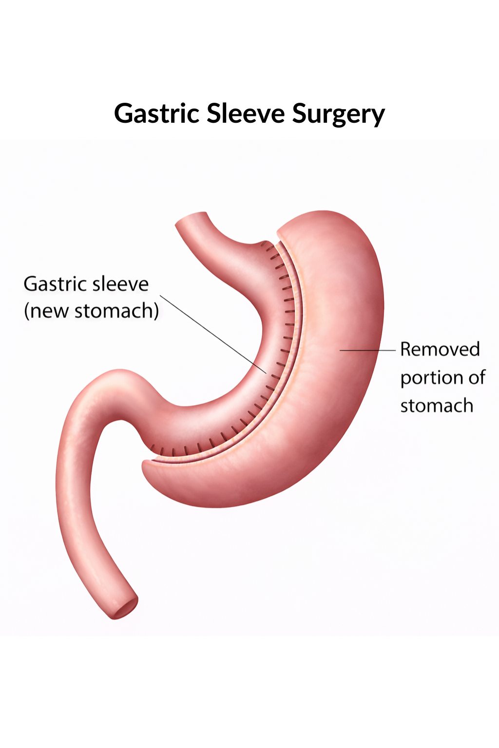 Gastric Sleeve at Clinic 360