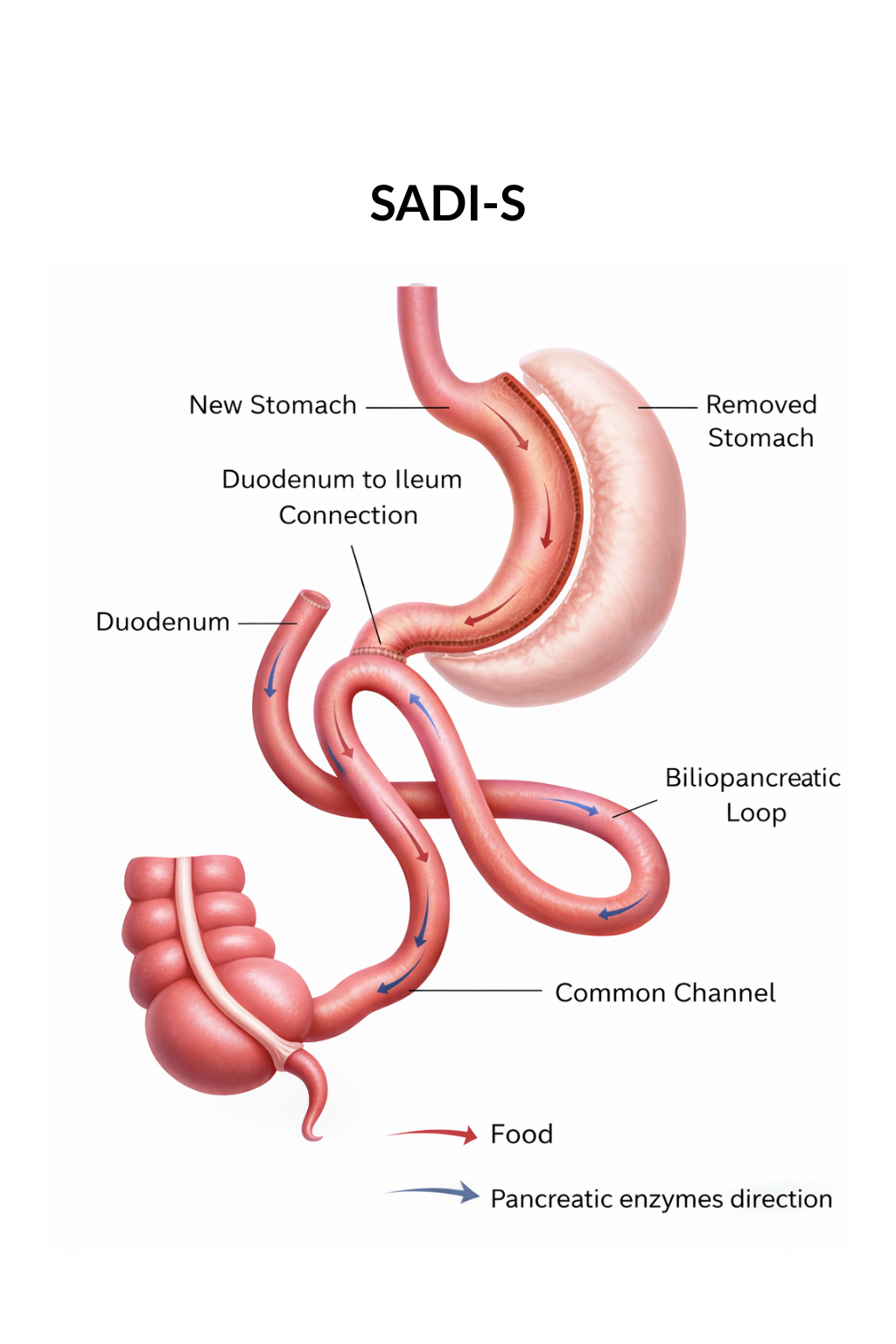 SADI-S at Clinic 360
